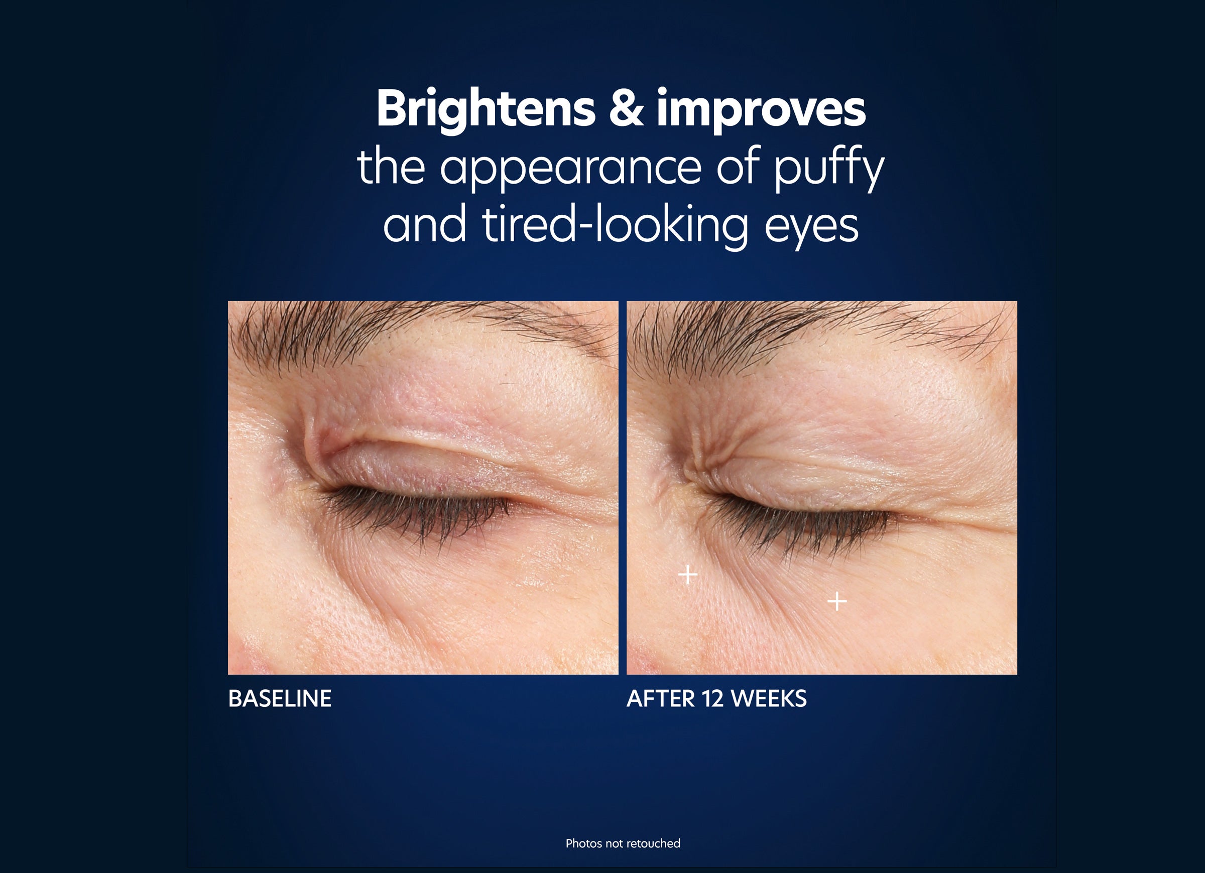 The image shows a comparison of the skin around the eyes before and after 12 weeks of using Hyaluronic Acid Microneedle Eye Patches. The "Before" photo depicts puffy and tired-looking eyes, while the "After 12 Weeks" photo shows a significant improvement with reduced puffiness. Text reads: "Brightens & improves the appearance of puffy and tired-looking eyes.
