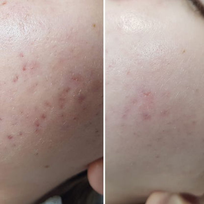 Side-by-side cheek comparison before and after using A-QS Hacker Day Cream 50ml, showing less redness and fewer acne spots post-application.