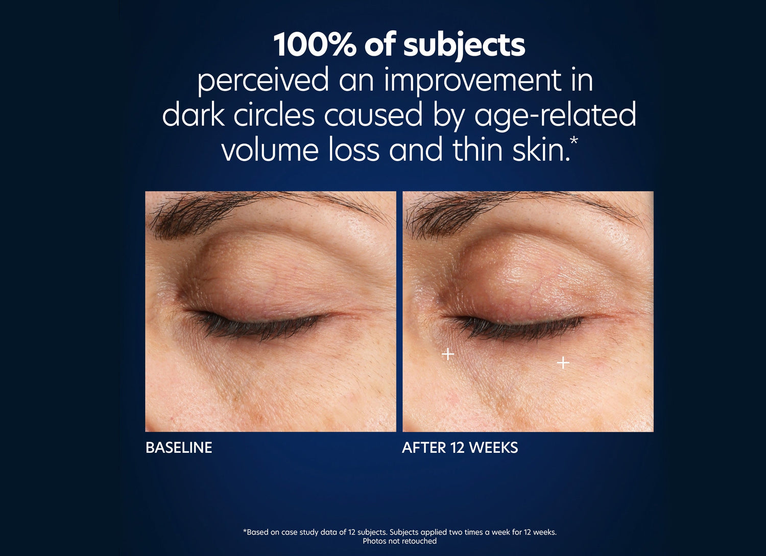 Side-by-side comparison images of an eye area, showing reduced dark circles after 12 weeks of treatment with Hyaluronic Acid Microneedle Eye Patches (4 sets). The left image is labeled &quot;Baseline,&quot; and the right image is labeled &quot;After 12 Weeks.&quot; Text above states that 100% of subjects saw improvements in dark circles with Hyaluronic Acid Microneedle Eye Patches.