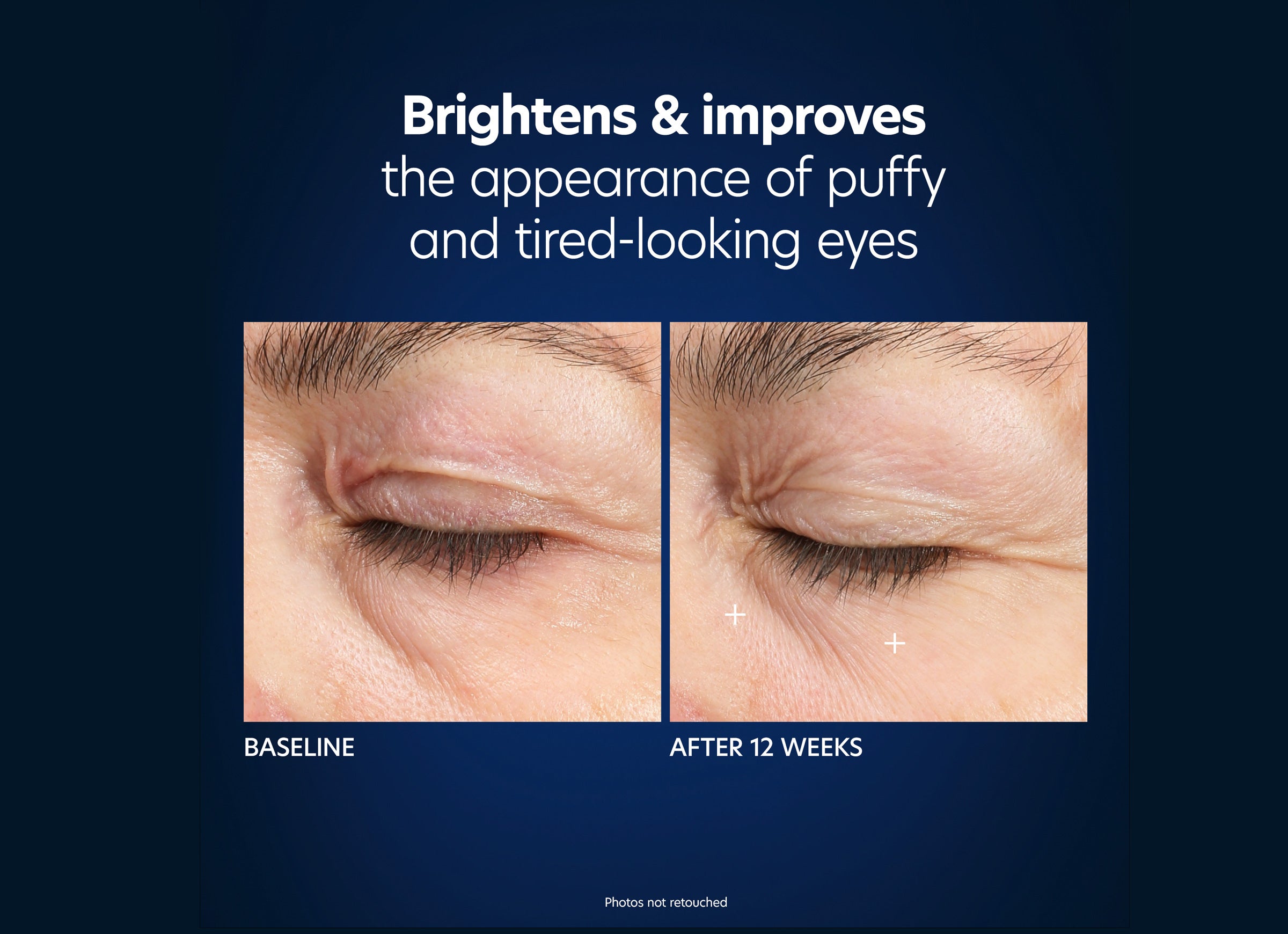 The image shows a comparison of the skin around the eyes before and after 12 weeks of using Hyaluronic Acid Microneedle Eye Patches. The &quot;Before&quot; photo depicts puffy and tired-looking eyes, while the &quot;After 12 Weeks&quot; photo shows a significant improvement with reduced puffiness. Text reads: &quot;Brightens &amp; improves the appearance of puffy and tired-looking eyes.